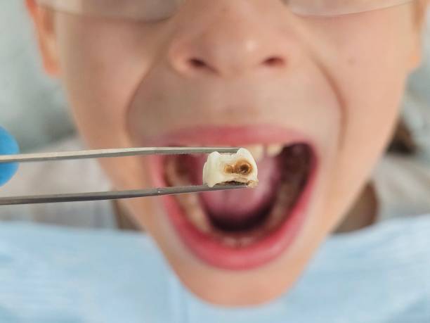 Best Emergency Dentist for Lost Fillings or Crowns in Rancho Palos Verdes, CA
